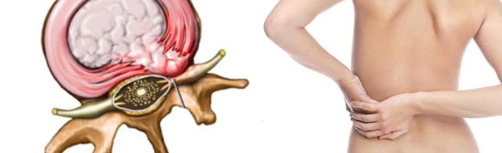 Disc herniation